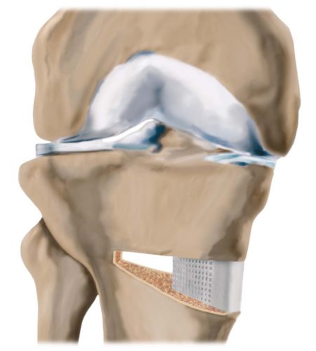Duowedge 2